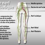 Quelques conseils pour contrer la sciatique