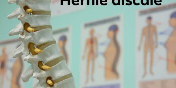 Hernie discale : la plus fréquente des lombalgies dans les carnets de santé